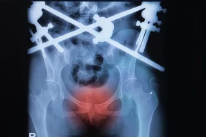 Causes Of Pelvic Fractures