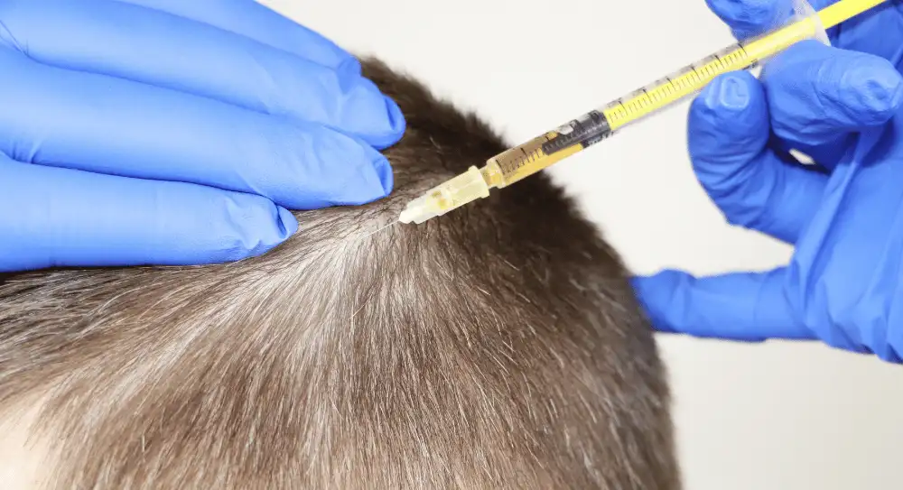 hair transplant