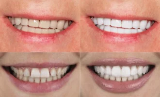 Porcelain Veneers