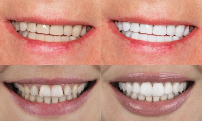 Porcelain Veneers